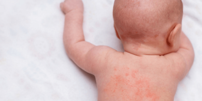 Obat Campak pada Bayi