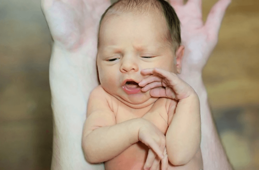 Penyakit Kuning pada Bayi