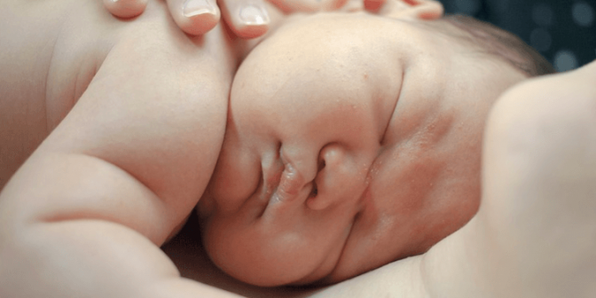 penyebab hidrosefalus pada bayi
