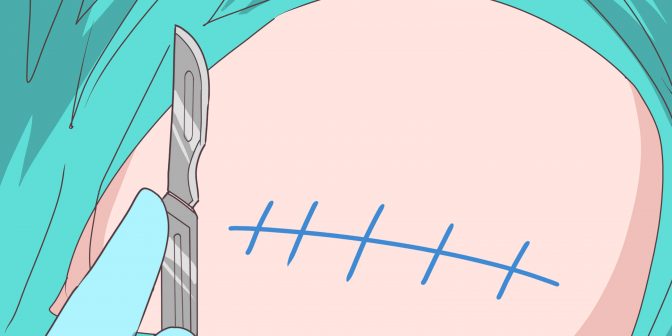 Melahirkan Normal setelah Caesar via wikihow.com