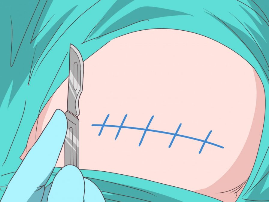 Melahirkan Normal setelah Caesar via wikihow.com