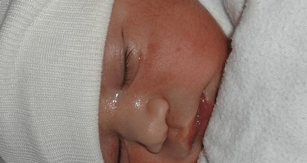 allergic march pada bayi