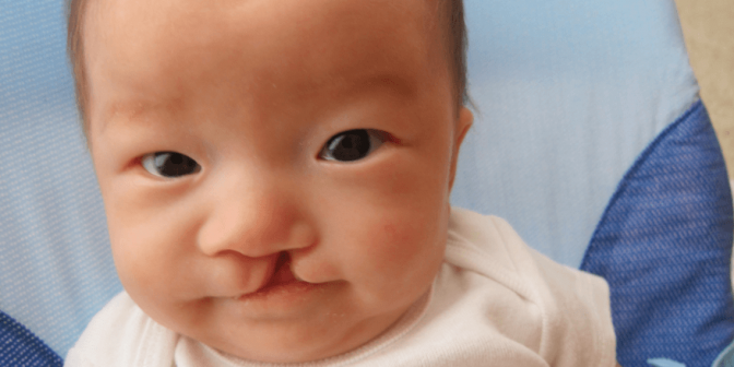 Bibir Sumbing pada Bayi