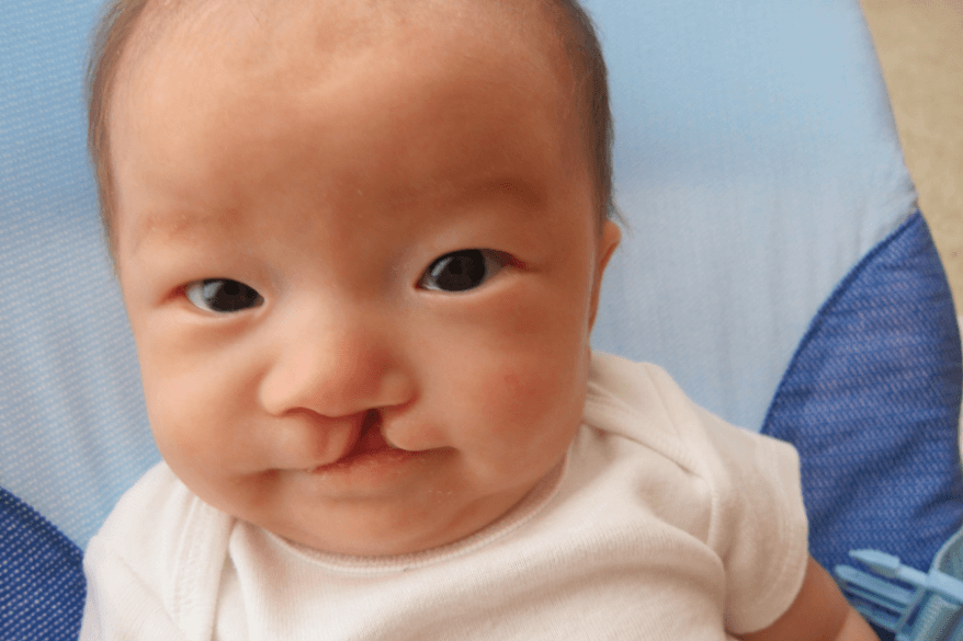 Bibir Sumbing pada Bayi