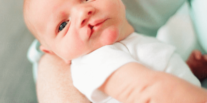 Bibir Sumbing pada Bayi