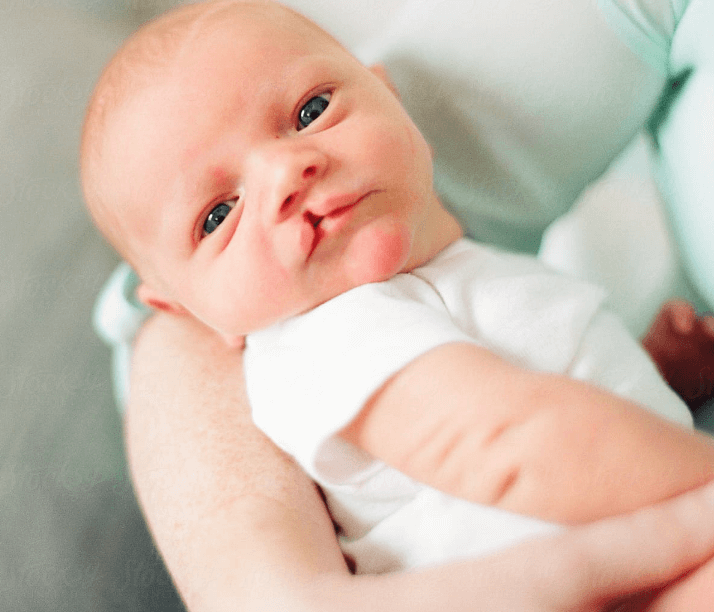 Bibir Sumbing pada Bayi