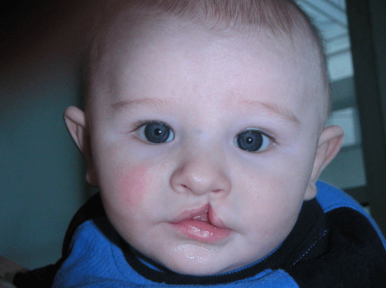 Bibir Sumbing pada Bayi