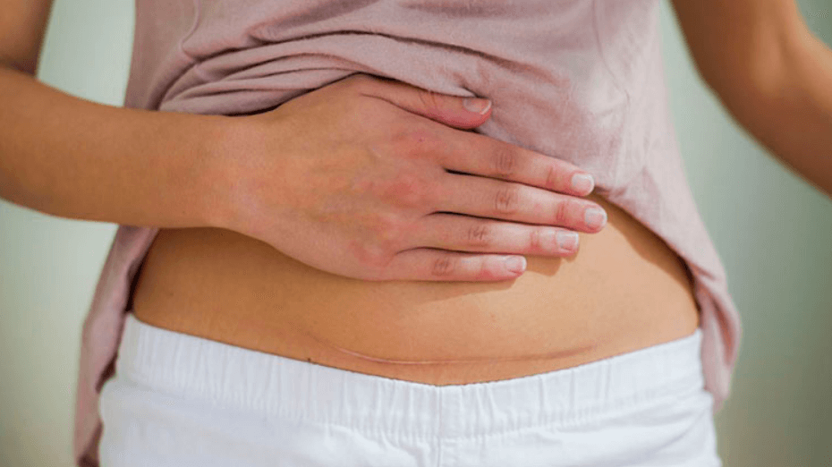 Infeksi Pasca Caesar