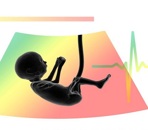 bayi meninggal dalam kandungan