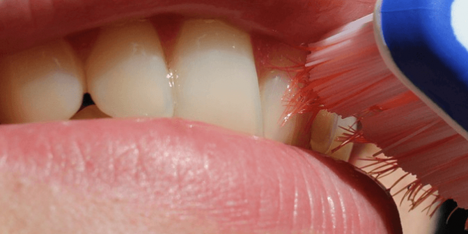 gusi bengkak saat hamil