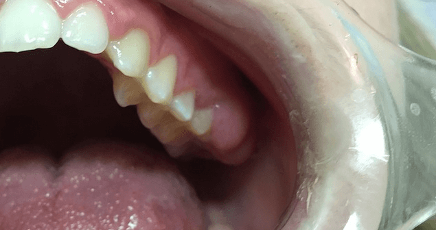 gusi bengkak saat hamil