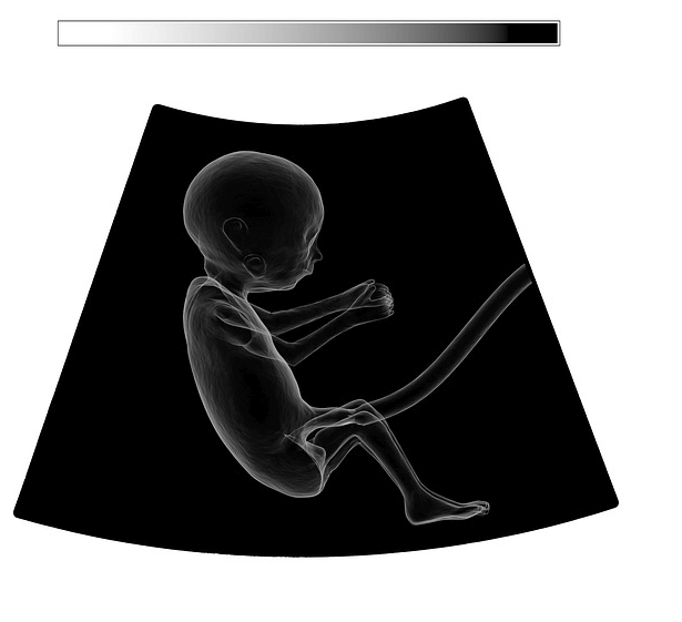 bayi meninggal dalam kandungan