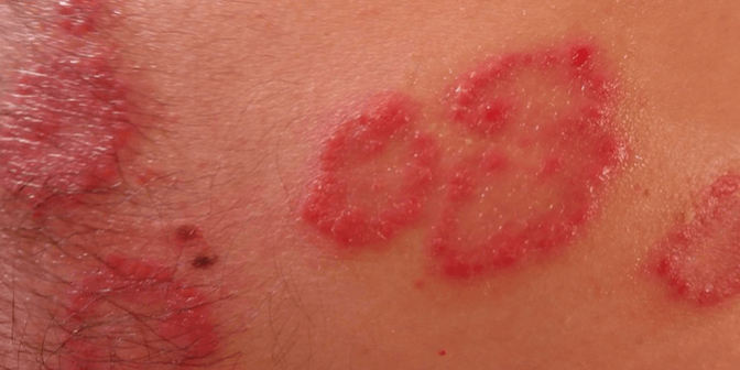 alergi kulit saat hamil