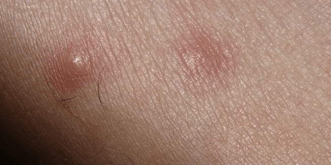 alergi kulit saat hamil