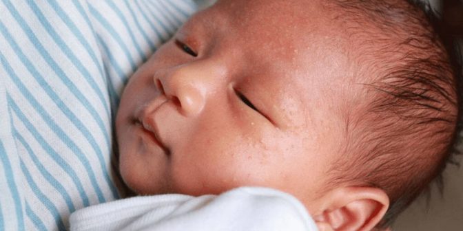 Bayi Alergi Susu Sapi