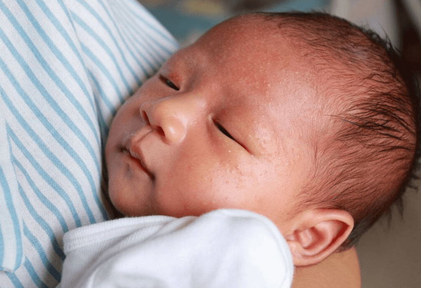 Bayi Alergi Susu Sapi