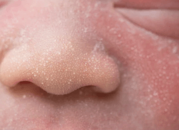 penyebab Milia pada bayi