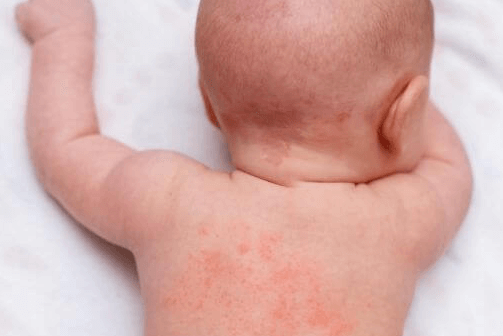 Penyebab Milia pada Bayi Beserta Gejala dan 4 Jenisnya