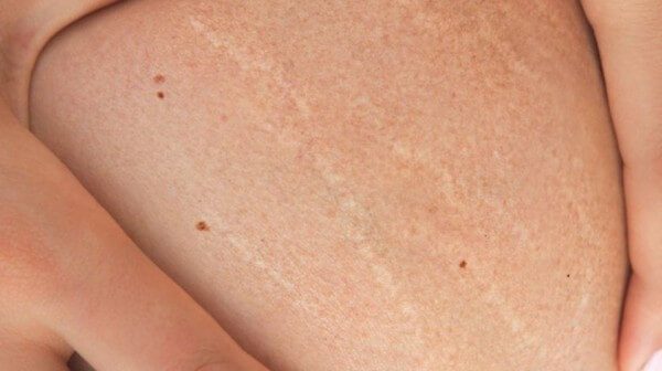 Beda Selulit dan Stretchmark