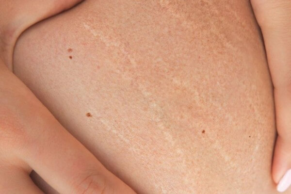 Beda Selulit dan Stretchmark