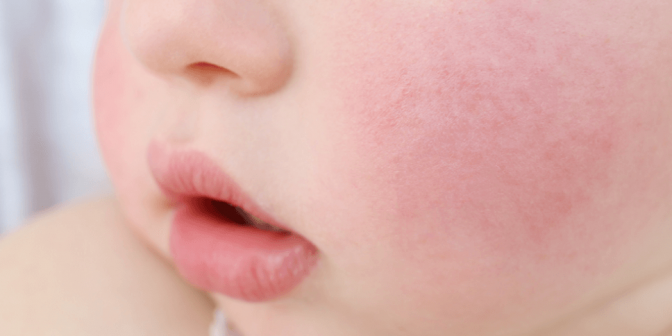 Bayi Alergi Susu Sapi