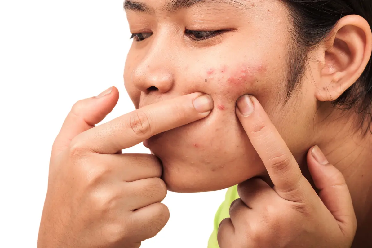 Moisturizer Hada Labo untuk kulit berjerawat