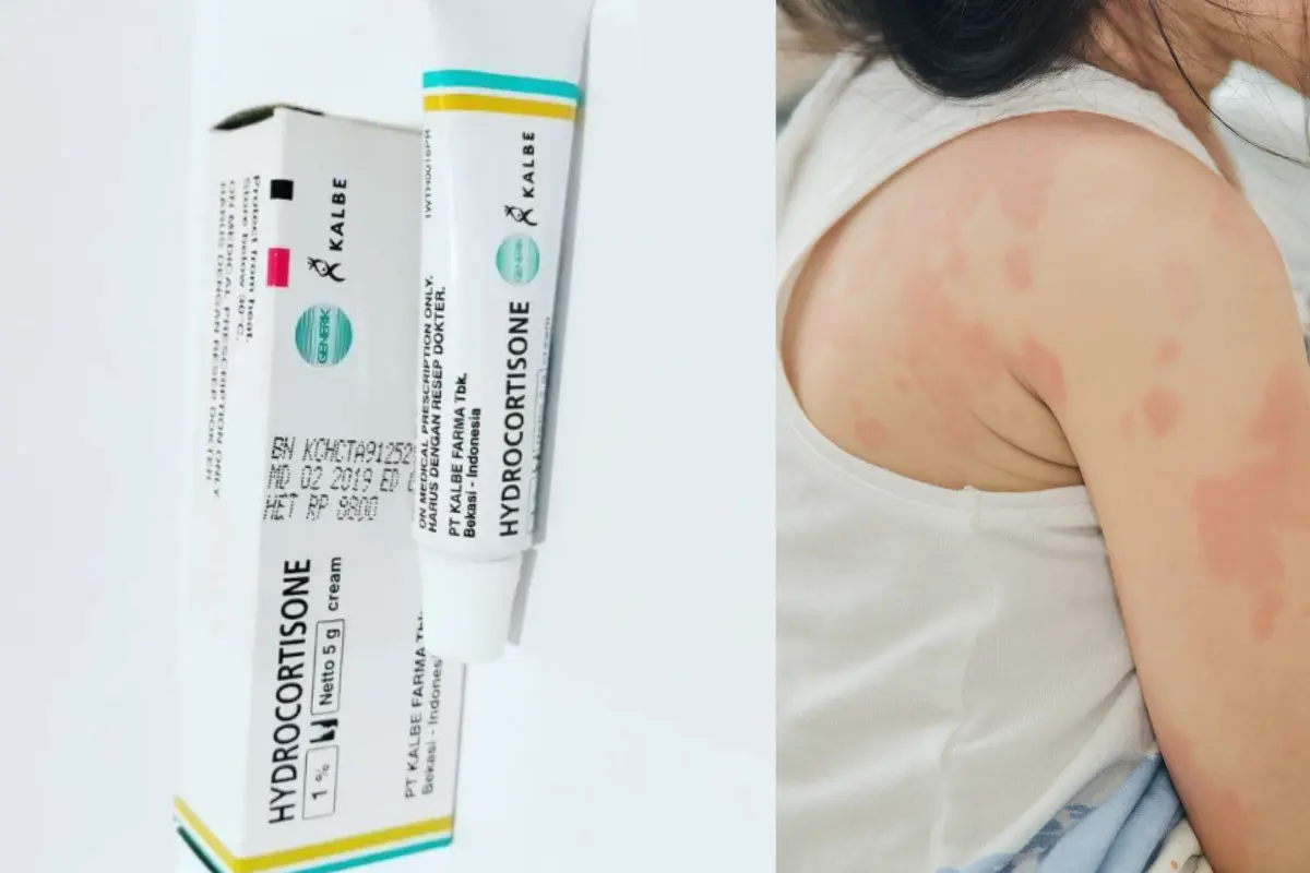 salep gatal berair untuk anak