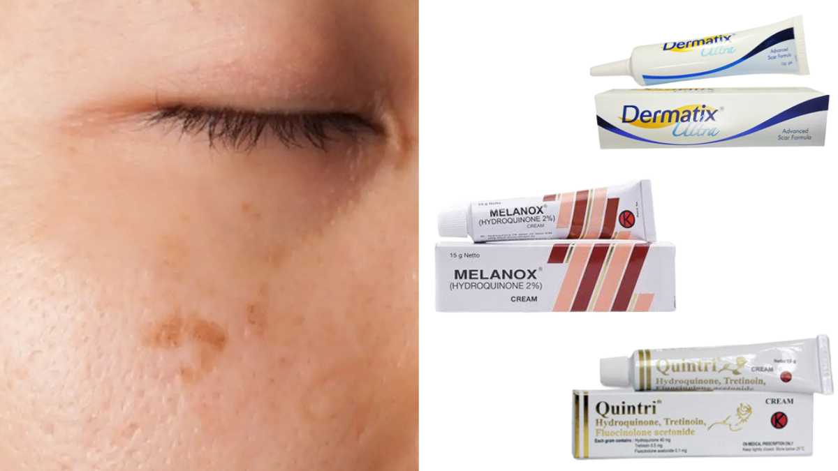 Cream Penghilang Flek Hitam Usia 40 Di Apotik