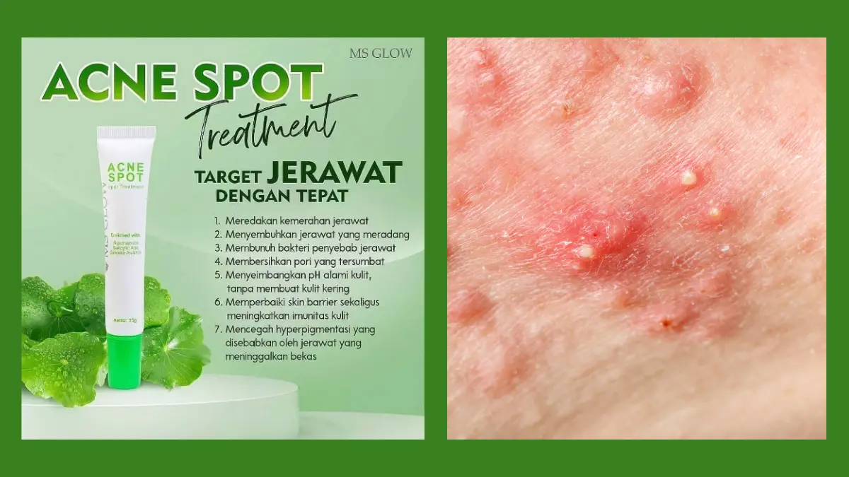 Acne Spot MS Glow
