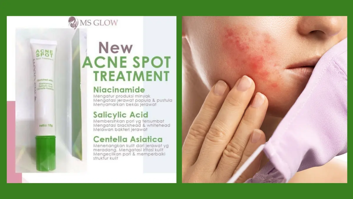 Acne Spot MS Glow