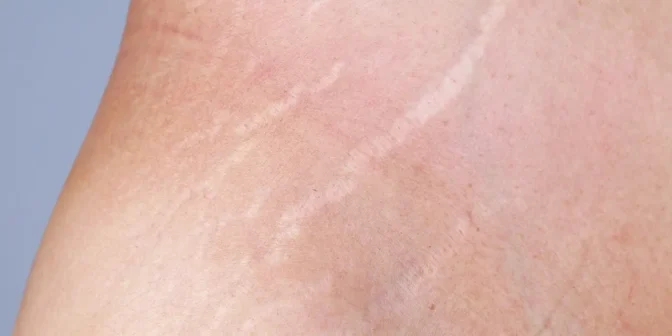Cara menghilangkan stretch mark dengan baby oil