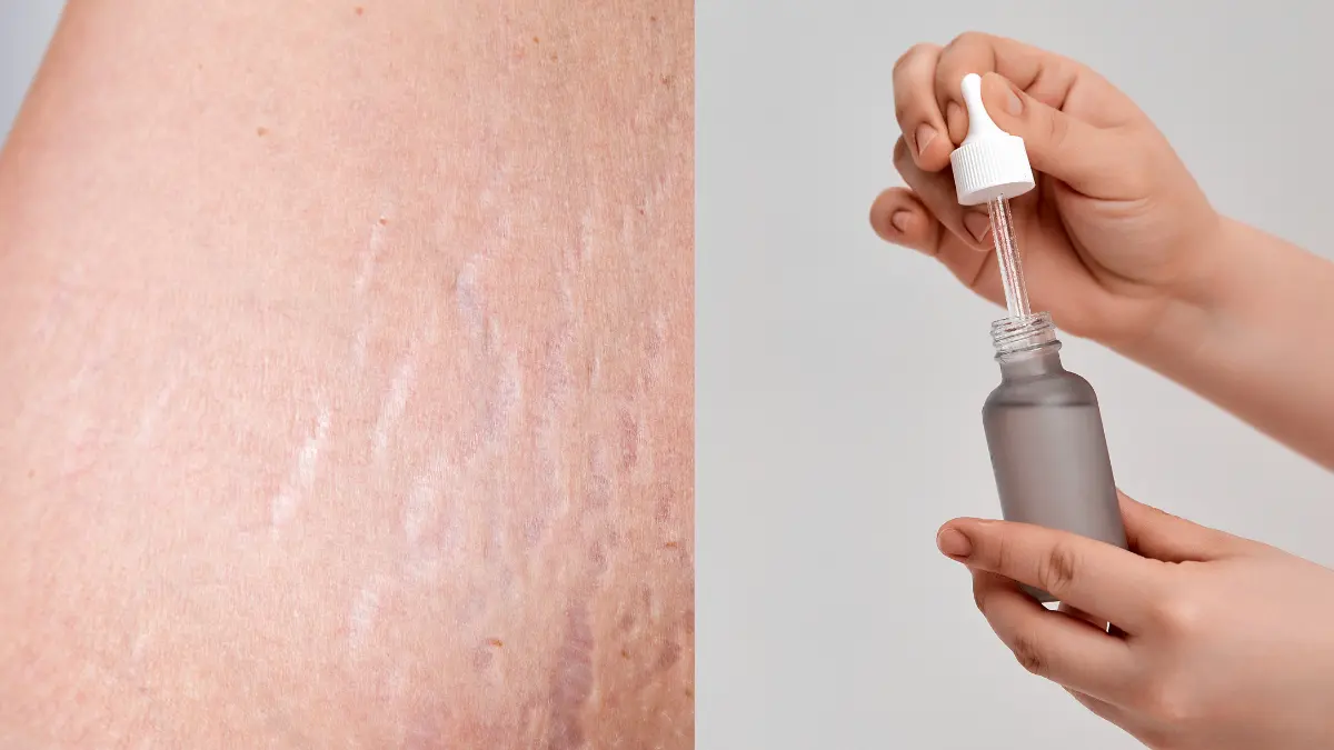 Cara menghilangkan stretch mark dengan baby oil