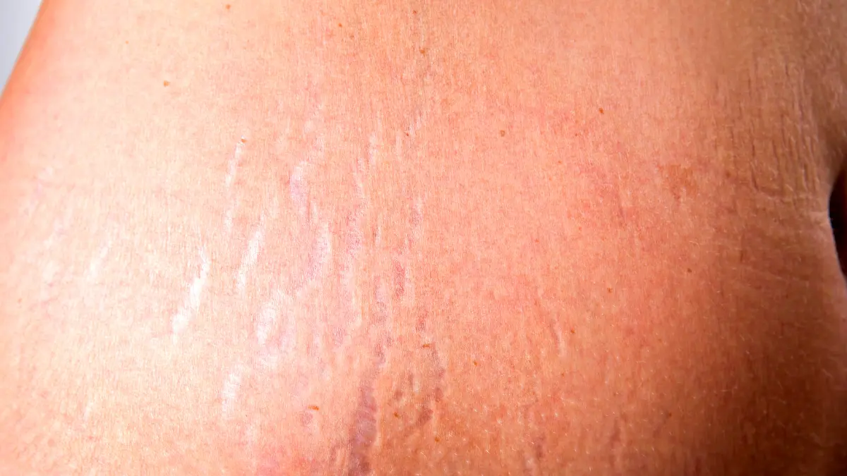 Stretch mark ibu hamil