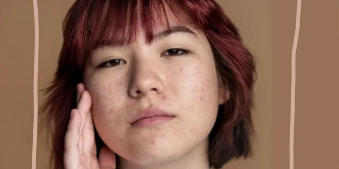 Cara menghilangkan kulit ayam di wajah 