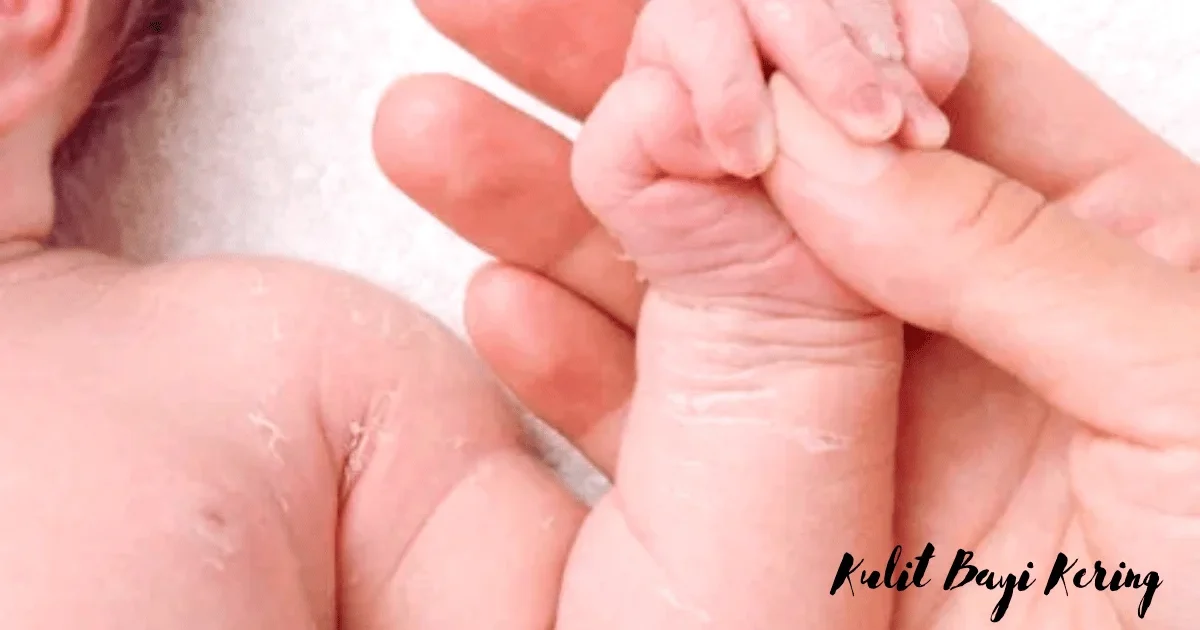Kulit Bayi Kering