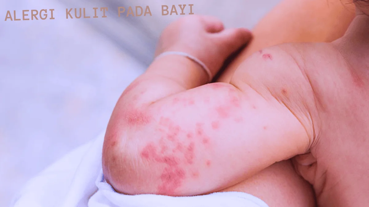 Alergi Kulit pada Bayi