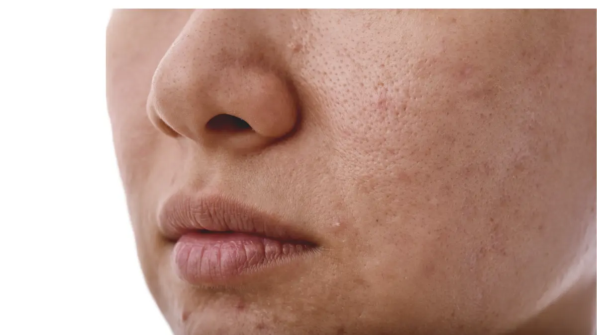 Ciri Ciri Skincare Tidak Cocok