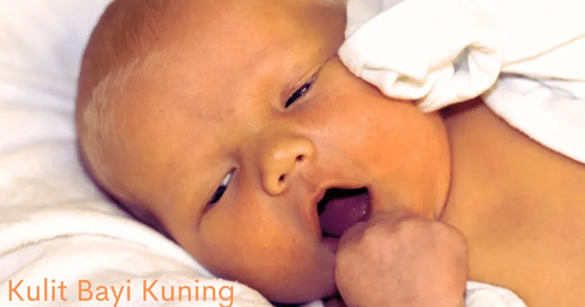 Kulit Bayi Kuning