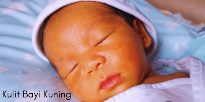 Kulit Bayi Kuning