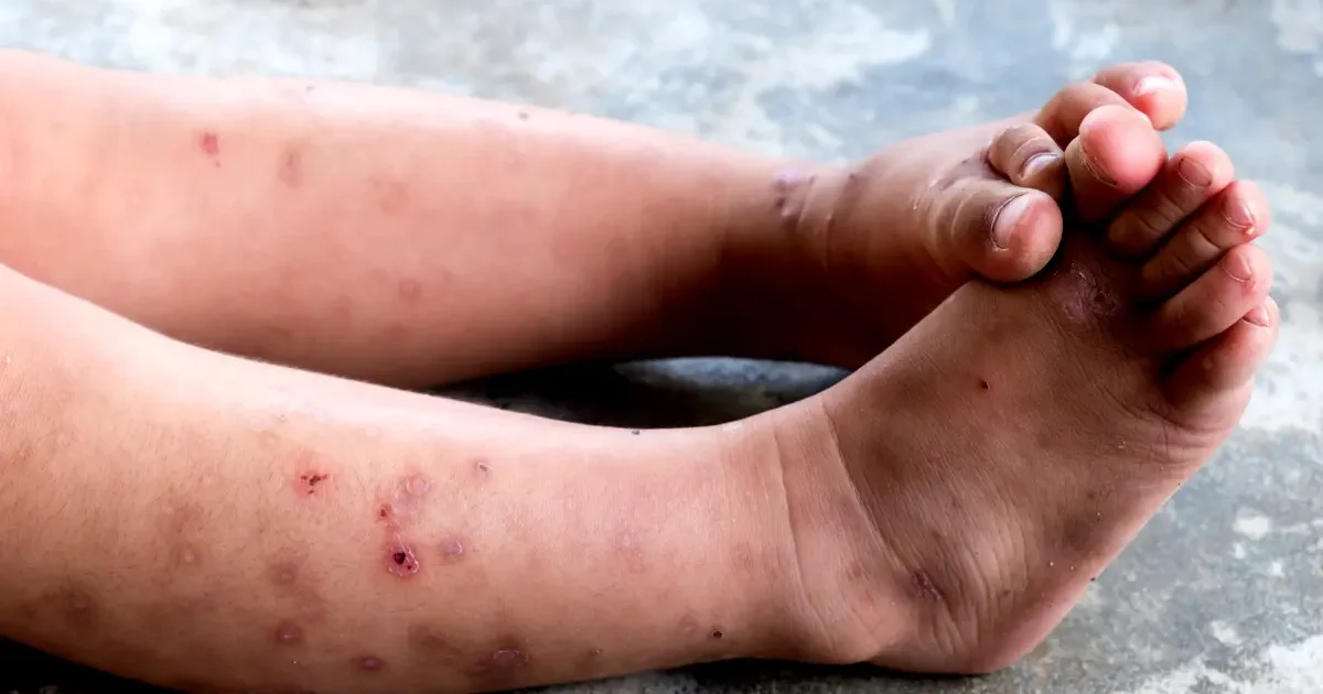 Penyakit Kulit Bernanah pada Bayi