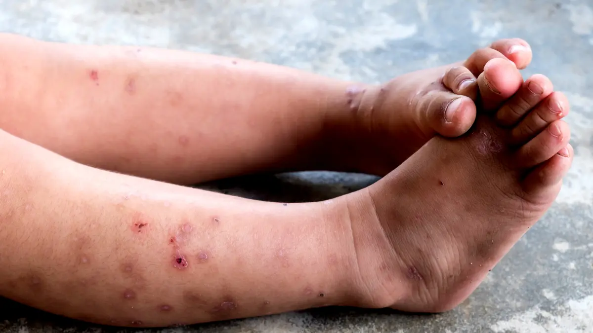 Penyakit Kulit Bernanah pada Bayi