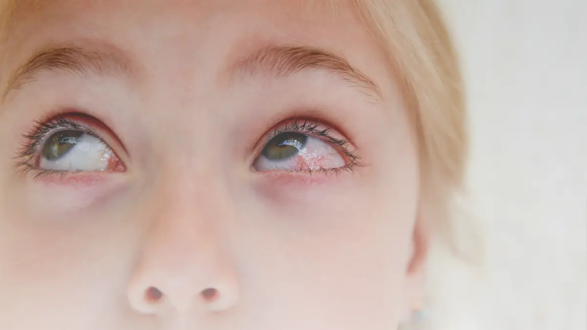 Mata Merah Pada Anak, Kenali Penyebab dan Cara Mengatasinya