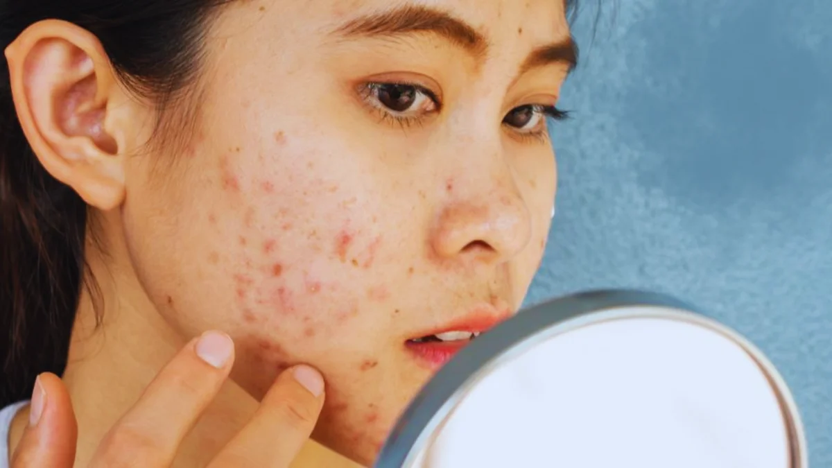 Produk eksfoliasi untuk wajah berminyak dan berjerawat